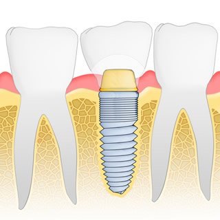 A diagram depicting a dental implant at Staten Island ental Care