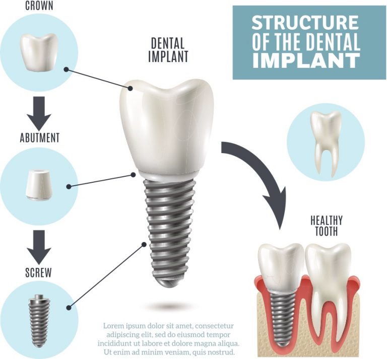 Why The Tooth Implant Timeline is Necessary General and Cosmetic Dentistry Staten Island