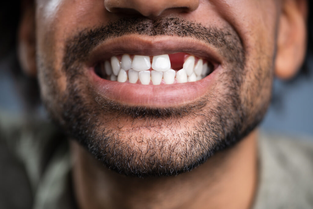 closeup of a man with a knocked out tooth