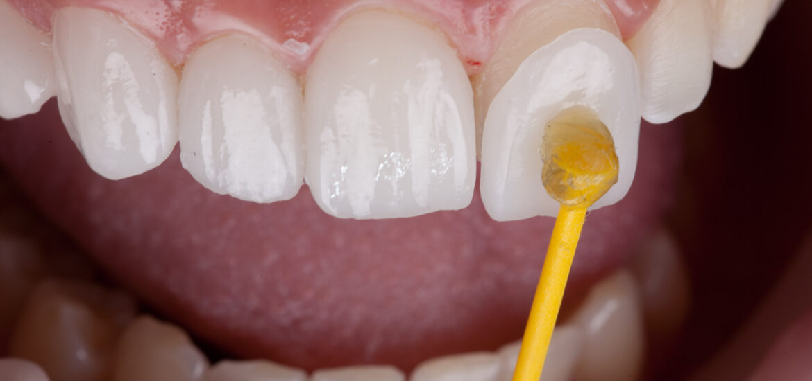 up close dental veneer application