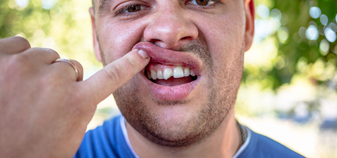 young man in a blue shirt exposing his chipped tooth