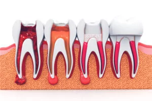 Graphical diagram of the stages of a root canal