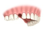 Preparing for dental implant placement - Staten Island Dental Care