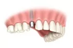 Dental implant placement - New York