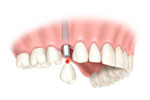 Attaching a dental crown to dental tooth implants - Staten Island Dental Care